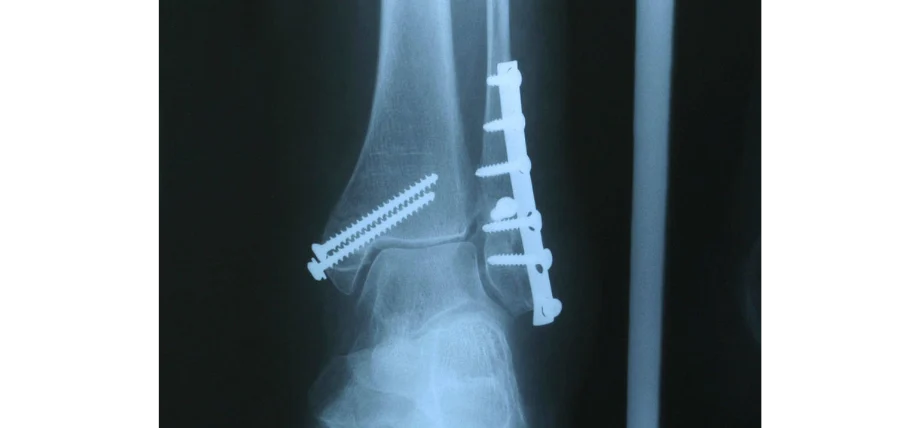 X-ray of bone screws set in an ankle 