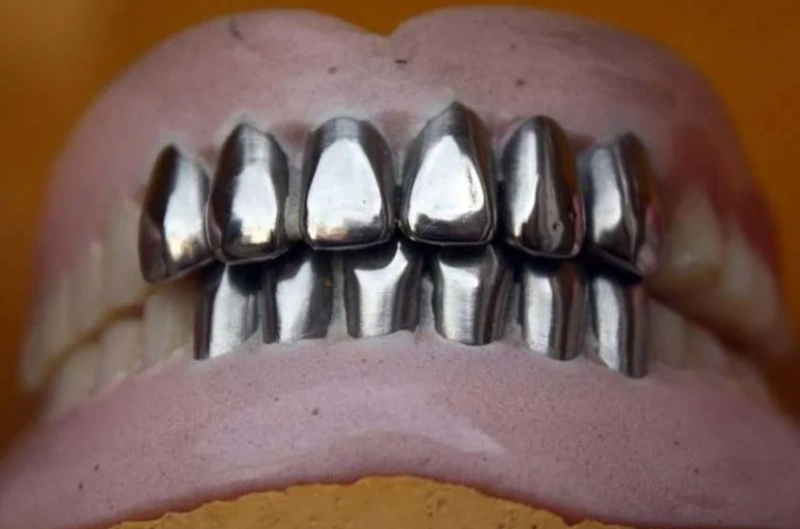 An image of several stainless steel dental implants on a dental model